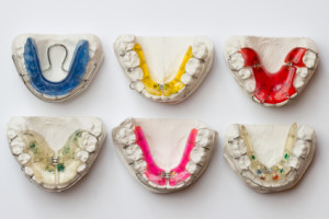 bunte Zahnspangen in Abdruckformen