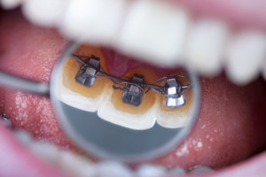 Dental mirror showing braces